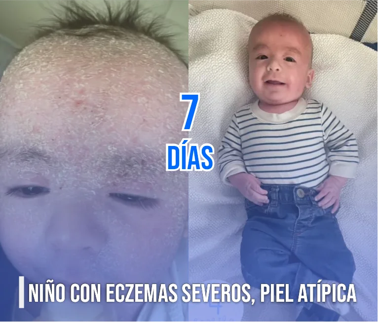 Testimonio de eszema con tarjeta cuantica